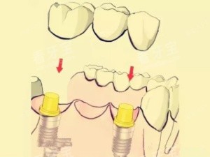 钛合金烤瓷牙漫画示意图 钛合金烤瓷牙漫画示意图