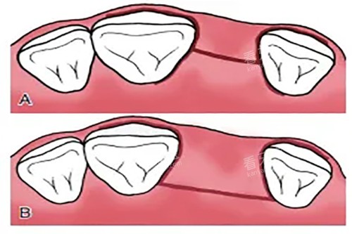 传统翻瓣种植牙切口卡通示意图 传统翻瓣种植牙切口卡通示意图