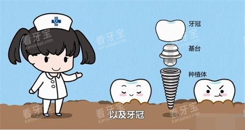 护士讲解种植牙结构漫画图 护士讲解种植牙结构漫画图
