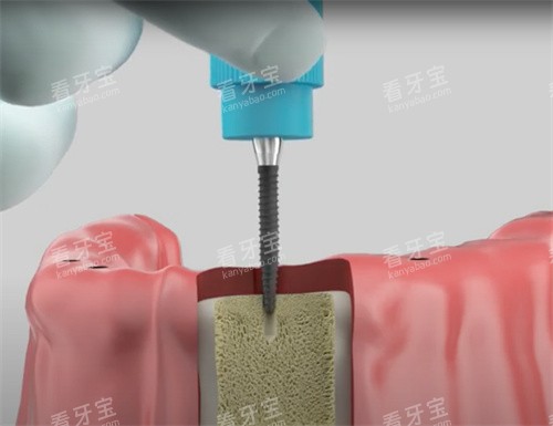 种植牙植体植入 种植牙植体植入