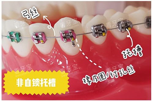 牙齿矫正非自锁托槽 牙齿矫正非自锁托槽