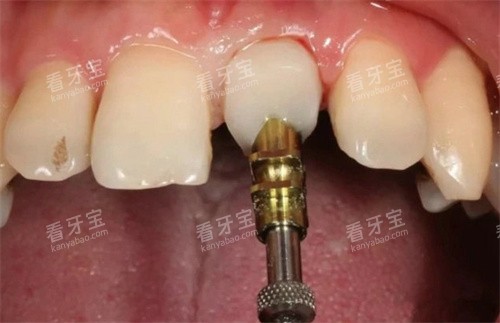 前牙美学修复实拍 前牙美学修复实拍