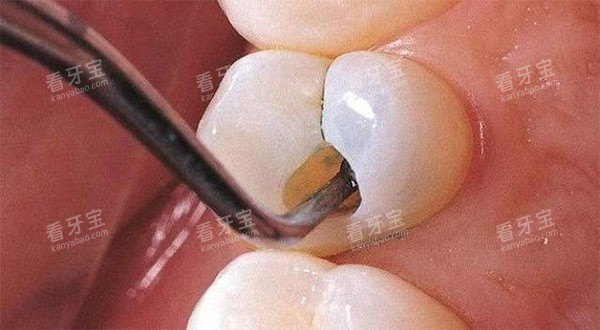 坏牙空洞怎么办 坏牙空洞怎么办