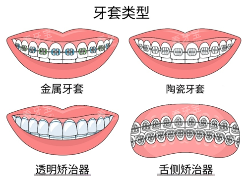 牙齿矫正常见方式 牙齿矫正常见方式