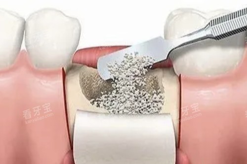 种植牙植骨图片展示 种植牙植骨图片展示