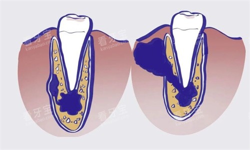 牙齿根尖囊肿 牙齿根尖囊肿