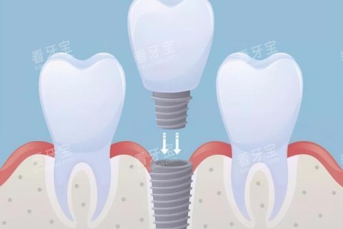 ��ֲ��ֲ�뿨ͨͼ