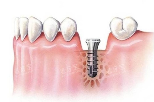 ��ֲ��ֲ�벽��ͼ