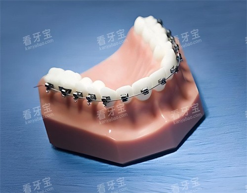 牙齿矫正模型展示图片 牙齿矫正模型展示图片