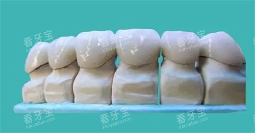 牙齿修复模型图 牙齿修复模型图