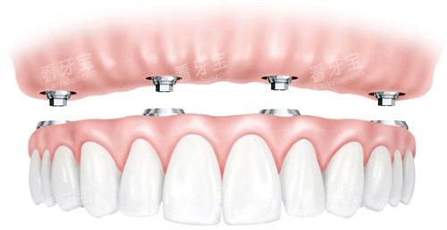 ALL ON 4 62 ALL ON 4 62