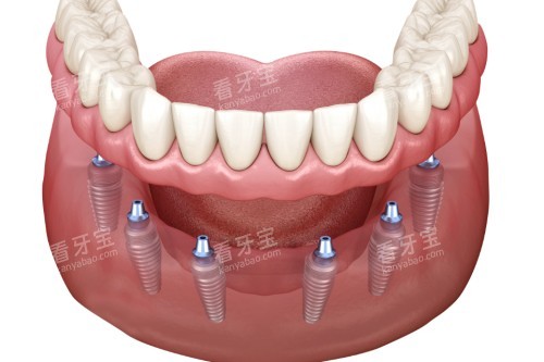 all-on-6种植卡通图 all-on-6种植卡通图