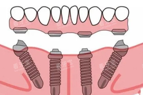 all-on-4种植模型展示图 all-on-4种植模型展示图