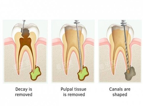 根管治疗步骤图卡通 根管治疗步骤图卡通