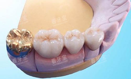 合金牙冠照片 合金牙冠照片