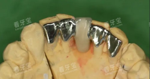 牙冠修复照片 牙冠修复照片