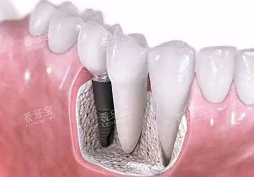 ��ֲ��ģ�߿�ͨͼ