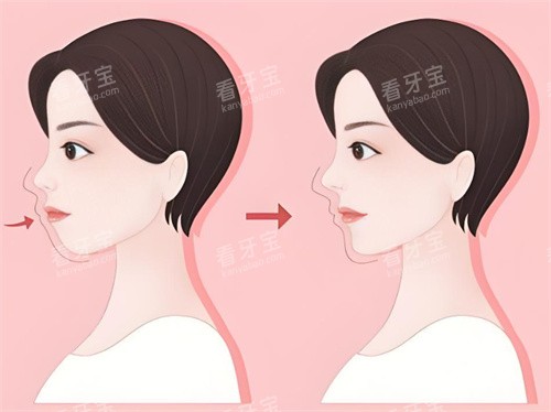 牙齿矫正前后对比 牙齿矫正前后对比