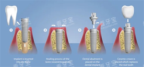 种植牙手术流程图 种植牙手术流程图