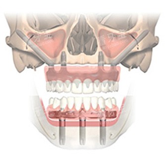 全口穿颧种植牙透视图 全口穿颧种植牙透视图