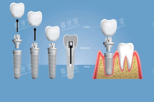 ��ֲ����װʾ��ͼ