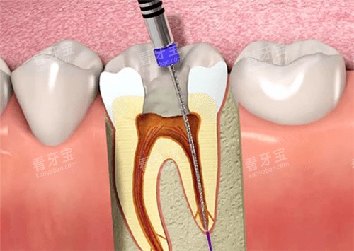 牙齿根管治填充 牙齿根管治填充