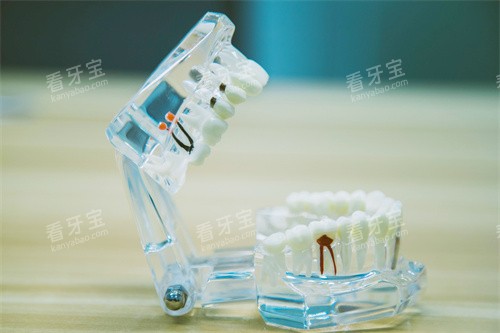 根管治疗牙齿模型 根管治疗牙齿模型