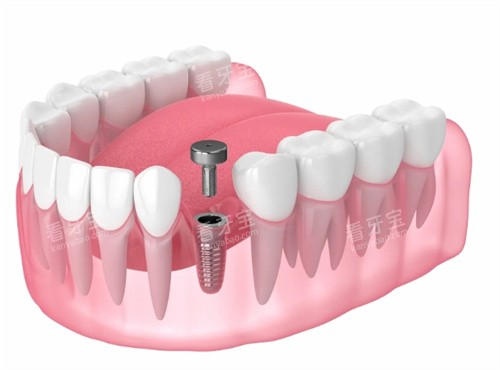 种植牙基台安装透视动画 种植牙基台安装透视动画