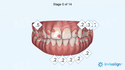 隐适美病例设计 隐适美病例设计