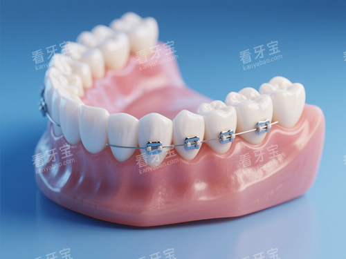 金属正畸模型 金属正畸模型