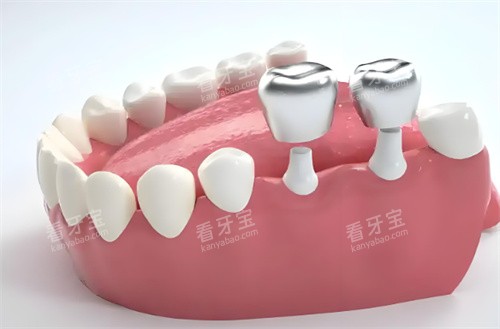 种植牙示意图片 种植牙示意图片