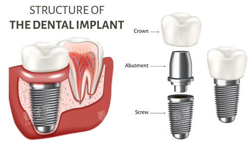 种植牙组件示意图 种植牙组件示意图