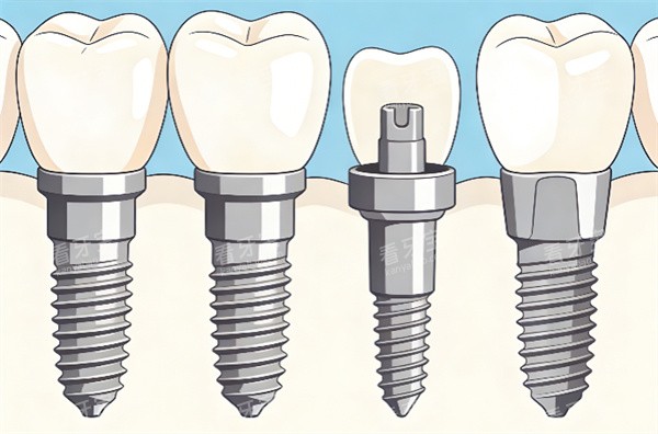 种植牙卡通示意图展示 种植牙卡通示意图展示