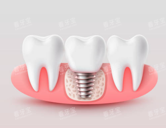 ��ֲ��ģ��ͼʾ��ͼ