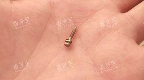 牙齿矫正骨钉种植钉3 牙齿矫正骨钉种植钉3