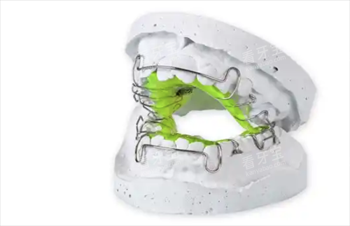 牙齿矫正扩弓器 牙齿矫正扩弓器