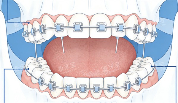 牙齿金属矫正图片展示 牙齿金属矫正图片展示