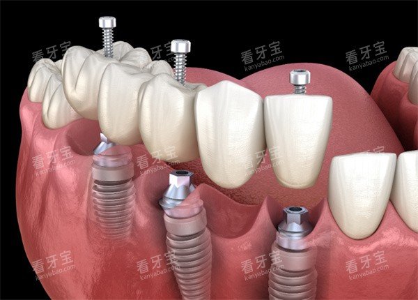 种植牙模型卡通示意图 种植牙模型卡通示意图