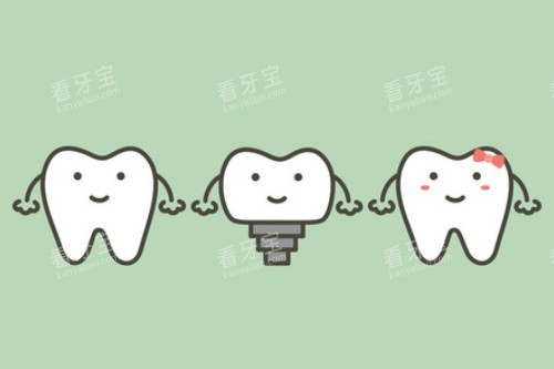 单颗种植牙卡通展示图 单颗种植牙卡通展示图