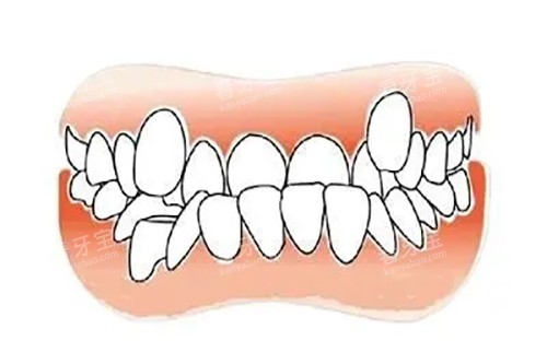 双排多生齿卡通示意图 双排多生齿卡通示意图