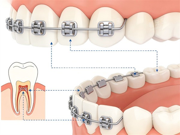 牙齿金属矫正示意图展示 牙齿金属矫正示意图展示