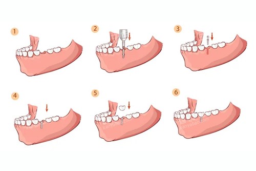 ����ֲ������ͼ��