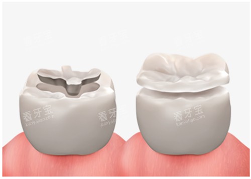 补牙动画图示 补牙动画图示