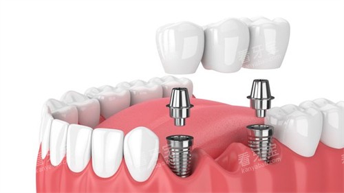 �����ֲ��ͼ