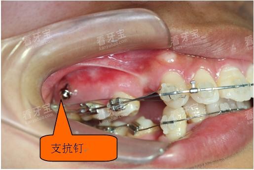 ���ݽ����Ƕ���ֲ����ǻʾ��ͼ