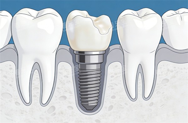 ������ֲ���廭ʾ��ͼ