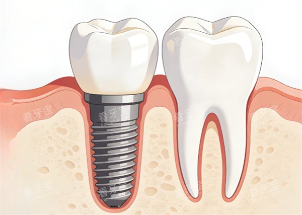 种植牙效果动画示意图 种植牙效果动画示意图