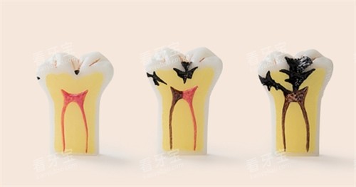 牙齿龋坏发展动画图 牙齿龋坏发展动画图