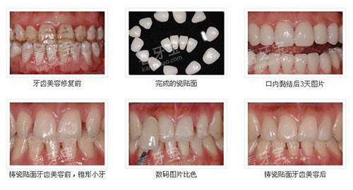 不同方式牙齿美白示意图 不同方式牙齿美白示意图