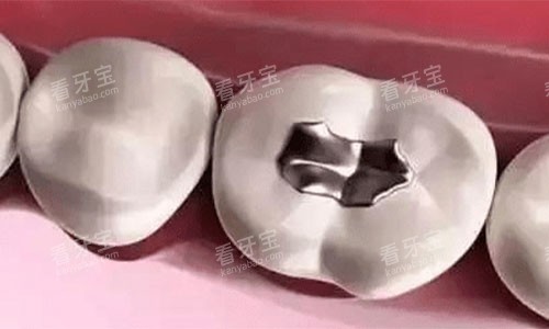 银汞合金的补牙术后 银汞合金的补牙术后